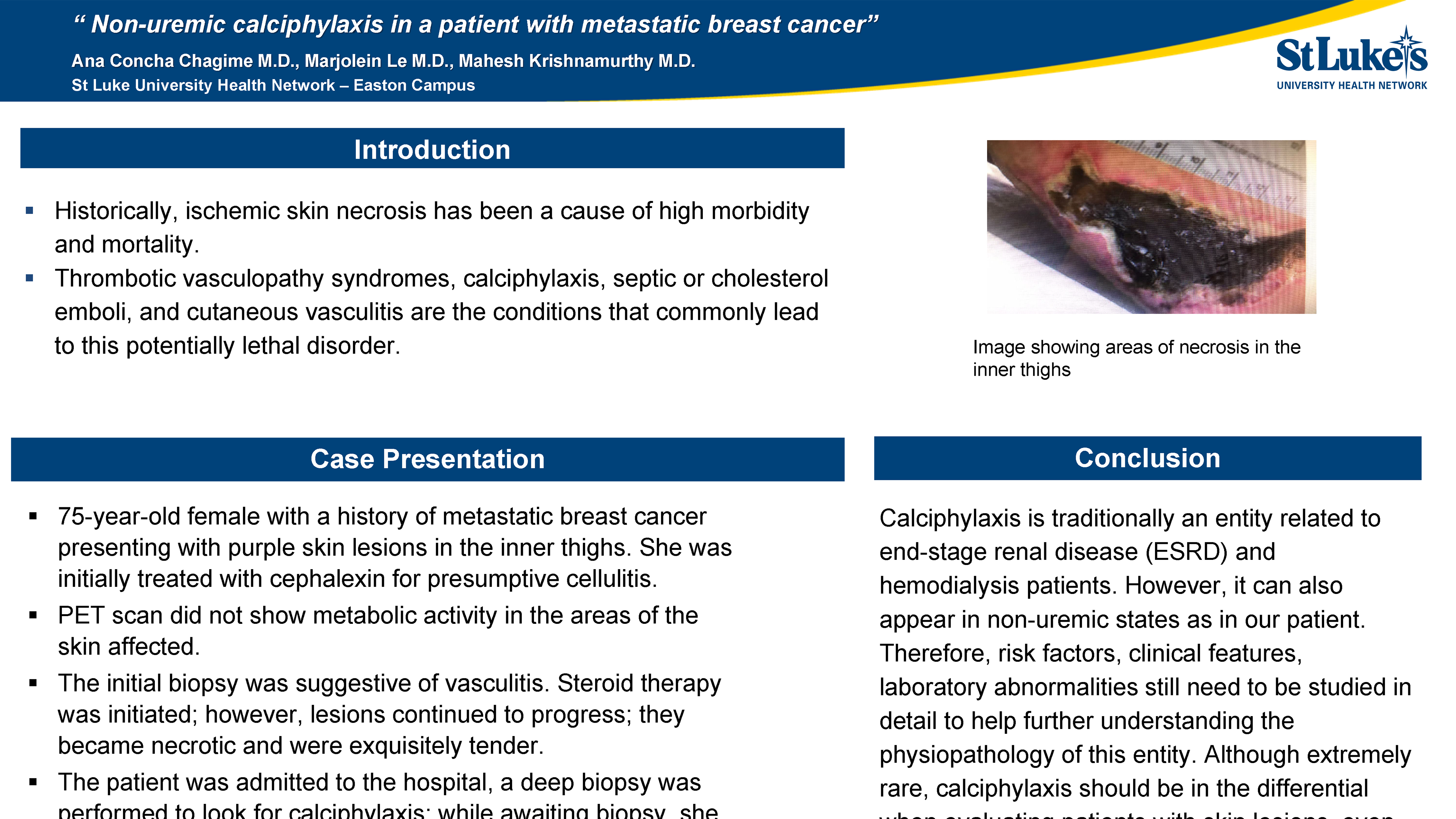 Ana V Concha - PAE 46 Non-uremic calciphylaxis in a patient with metastatic breast cancer