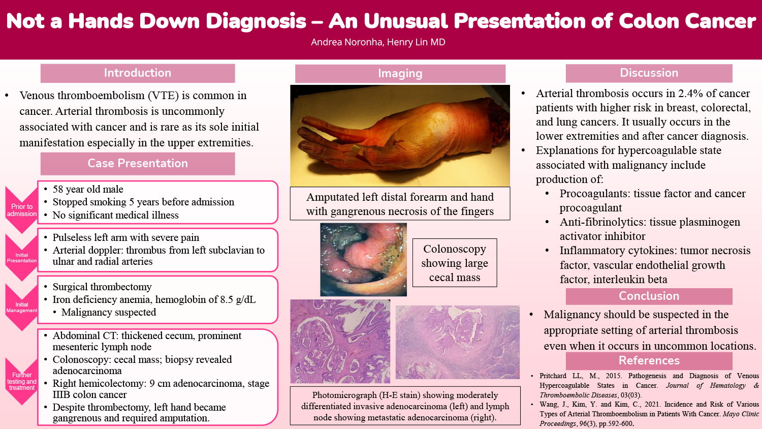 Andrea Noronha - PAS-62-Not-a-Hands-Down-Diagnosis-An-Unusual-Presentation-of-Colon-Cancer