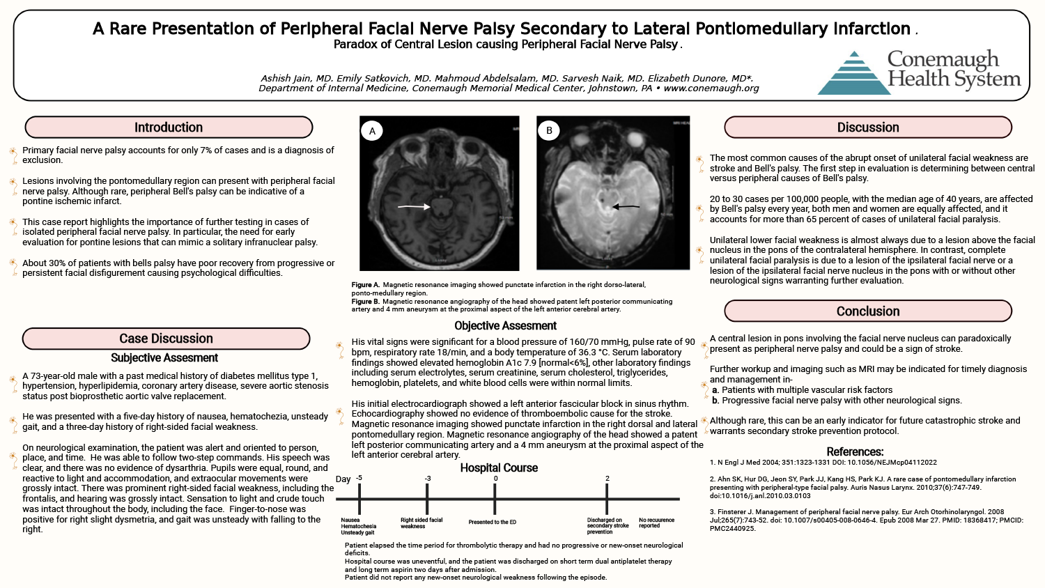 Ashish Jain - PAW-05-A-Rare-Presentation-Of-Peripheral-facial-palsy-secondary-to-lateral-pontomedullary-infarction-case-report