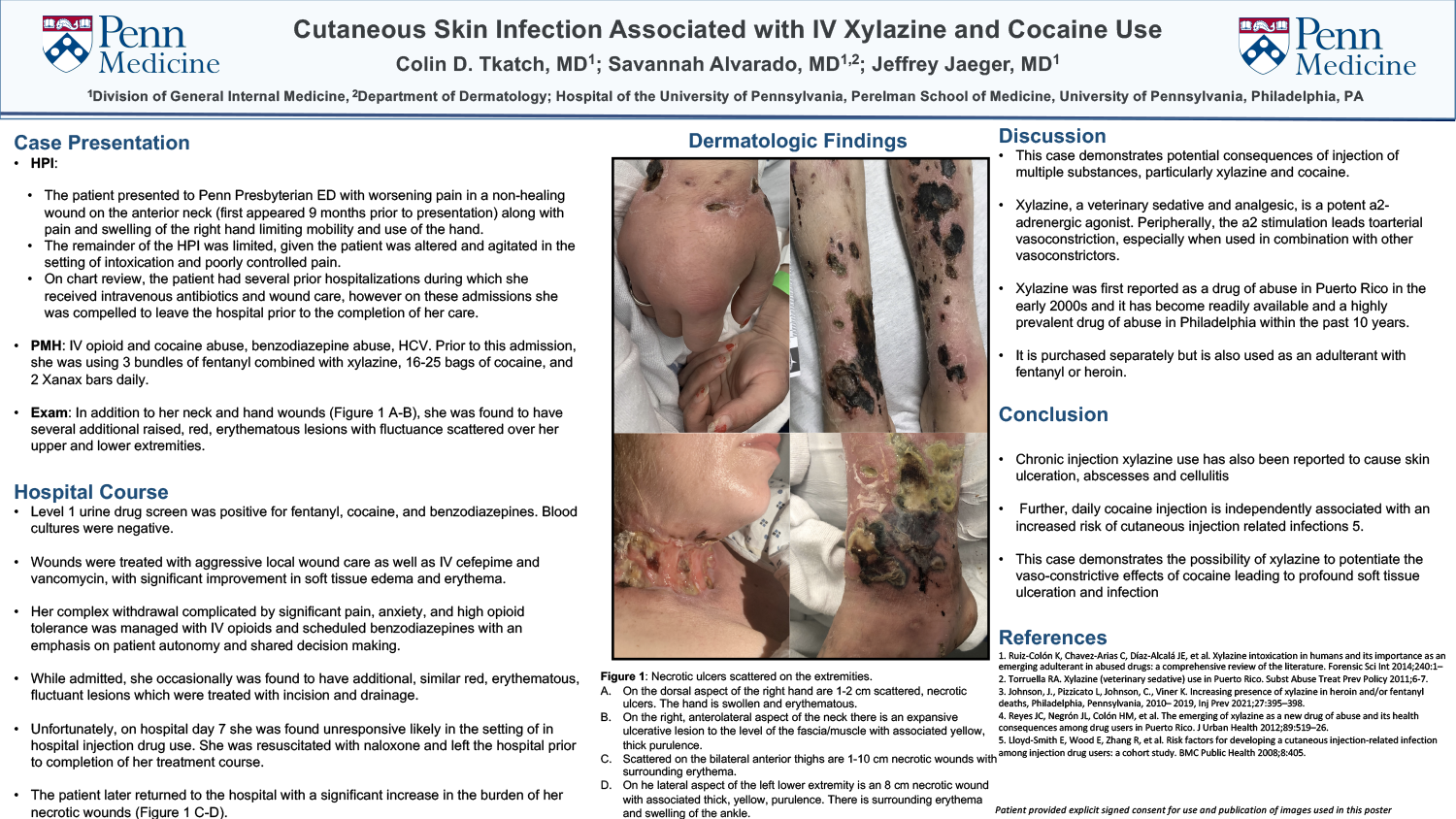 Colin Tkatch - PAS-30-Cutaneous-Skin-Infection-Associated-with-IV-Xylazine-and-Cocaine-Use