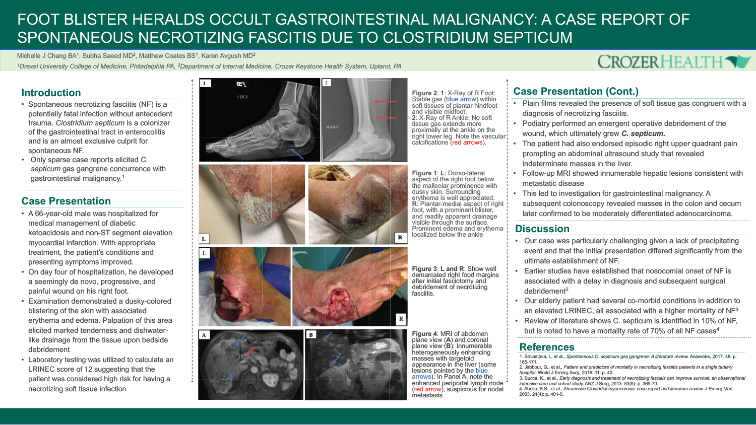 Michelle Chang - PAS-40-Foot Blister Heralds Occult Gastrointestinal Mlaignancy
