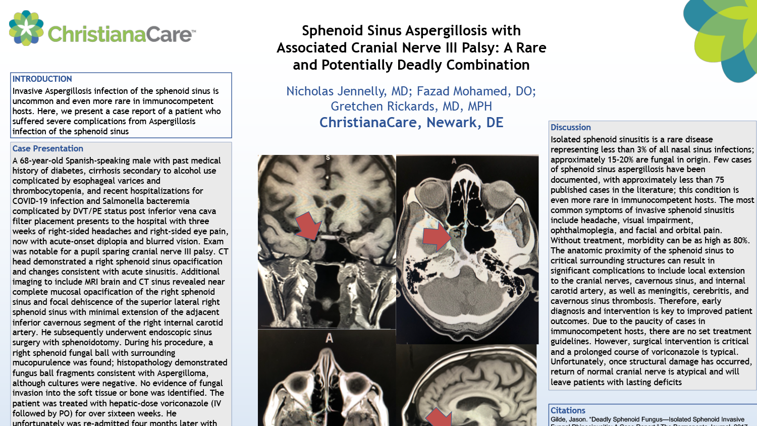 Nicholas Jennelly - PAS-77-Sphenoid-Sinus-Aspergillosis-With-Associated-Cranial-Nerve-III-Palsy-A-Rare-And-Potentially-Deadly-Combination