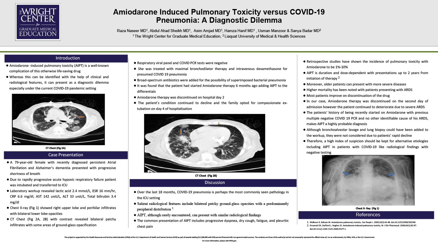 Raza Naseer - PAE- 36 - Amiodarone Induced Pulmonary Toxicity versus COVID-19-Pneumonia A Diagnostic Dilemma