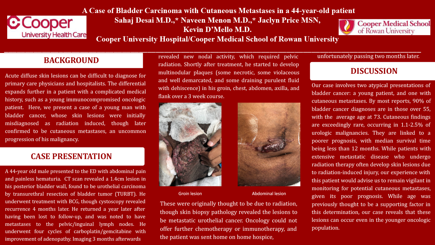 Sahaj Desai - PAS-2-A-Case-of-Bladder-Carcinoma-in-a-44-year-old-patient-with-Cutaneous-Metastases