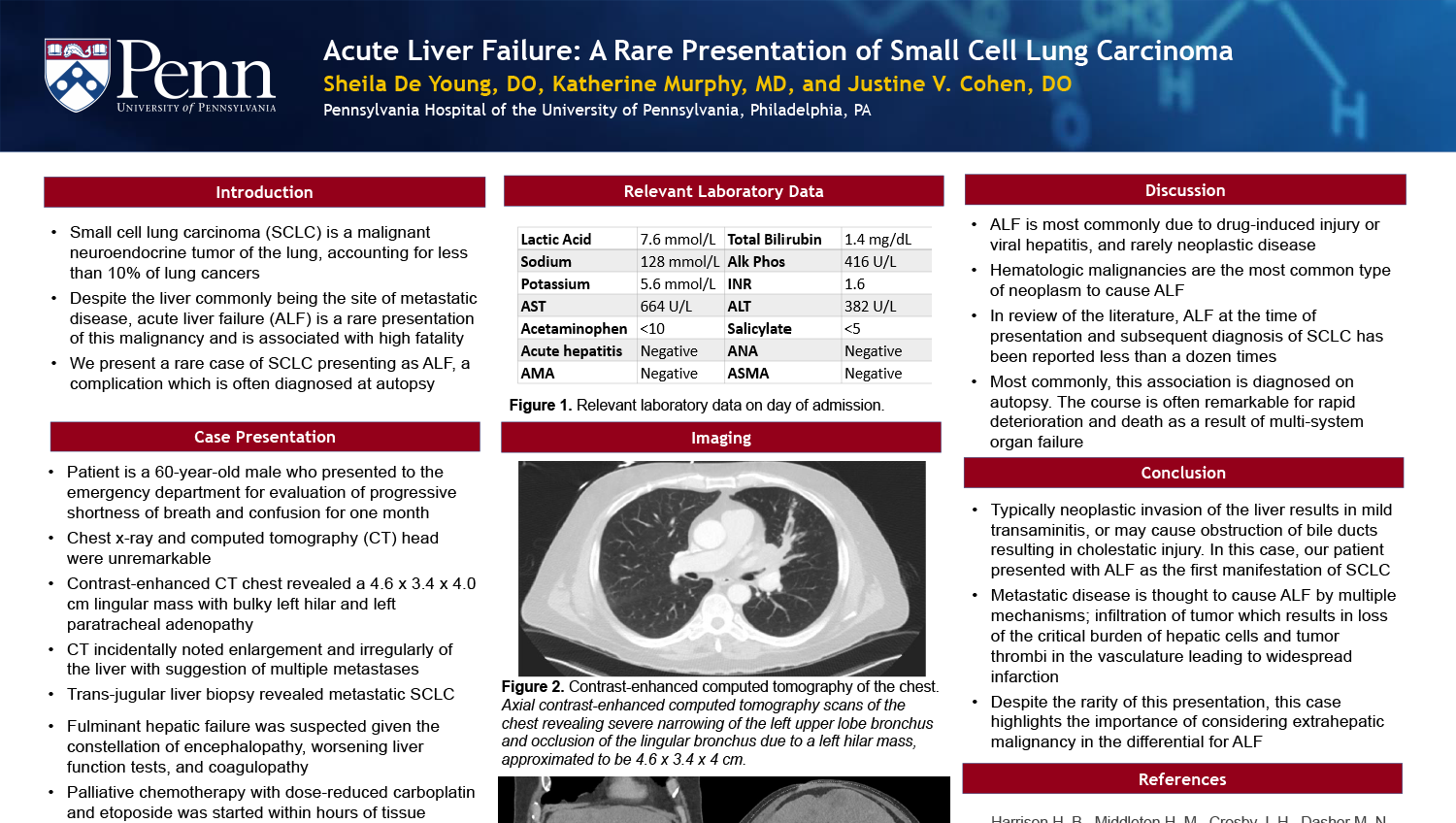 Sheila De Young - PAS-14-Acute-Liver-Failure-A-Rare-Presentation-of-Small-Cell-Lung-Cancer