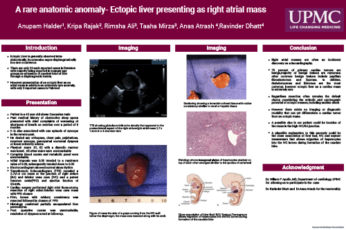 CE-9 -A rare anatomic anomaly-ectopic liver as right atrial mass Anupam Halder